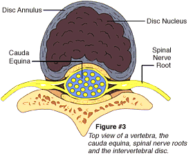 Sciatica