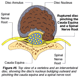 Sciatica